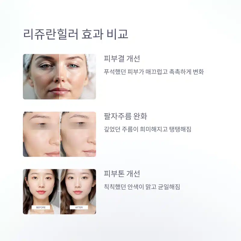 리쥬란힐러 비교 전후 사진 피부결 개선 팔자주름 완화 피부톤 개선