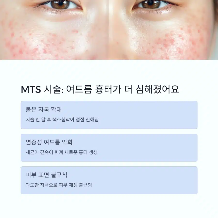 MTS 시술 후 여드름 흉터가 악화되고 착색된 피부 사례